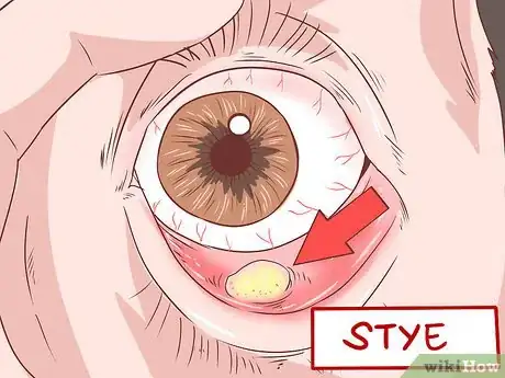 Image titled Identify Symptoms of MRSA Step 8