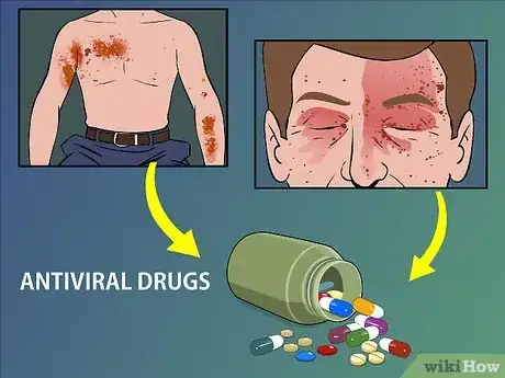 Image titled Treat Shingles (Herpes Zoster) Step 8