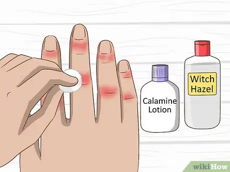 Image titled Get Rid of Chilblains Step 1