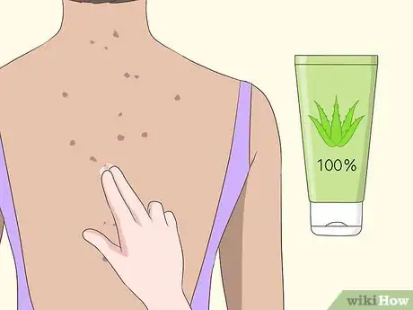 Image titled Get Rid of Back Acne Scars Step 9