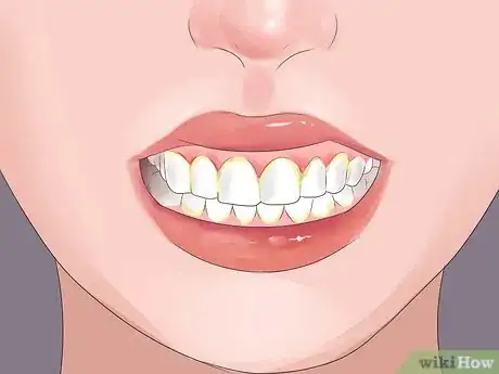 Image titled Stop Gum Recession Step 16