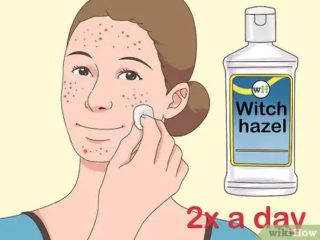 Image titled Get Rid of Acne Fast Step 7