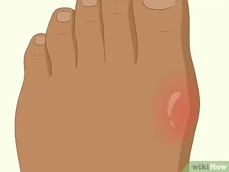 Image titled Recognize Gout Symptoms Step 5