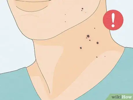 Image titled Remove a Mole with Iodine Step 13