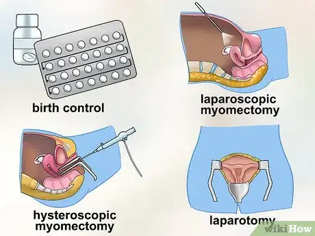 Image titled Diagnose Uterine Fibroids Step 7