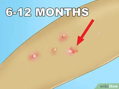 Image titled Recognize Molluscum (Molluscum Contagiosum) Step 9