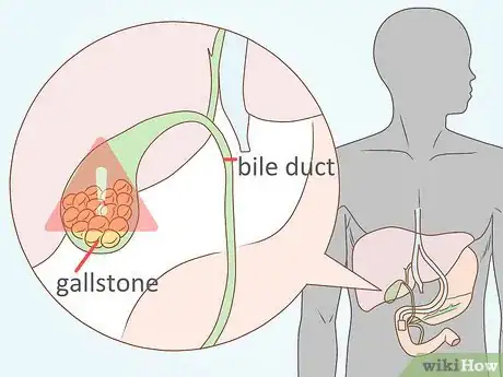 Image titled Avoid Foods That Cause Pancreatitis Step 2