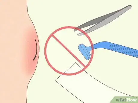 Image titled Remove Deep Ingrown Hairs Step 3