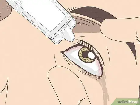 Image titled Get Dirt Out of Your Eye Step 6