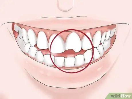 Image titled Know if Your Dental Fillings Need Replacing Step 9