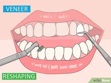 Image titled Fix an Underbite Step 9