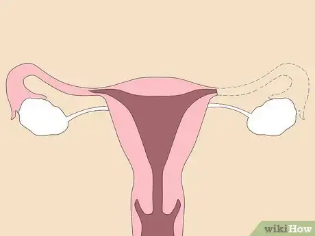 Image titled Unblock Fallopian Tubes Naturally Step 5