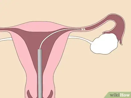 Image titled Unblock Fallopian Tubes Naturally Step 2