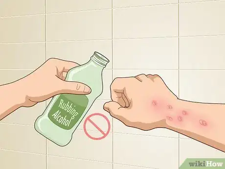 Image titled Get Rid of Poison Oak Rash Step 10