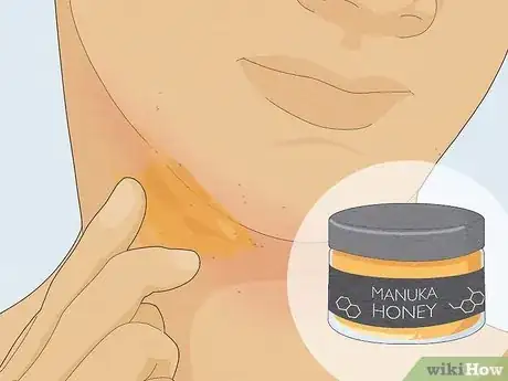 Image titled Reduce Redness After Waxing Step 13