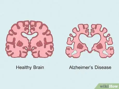 Image titled What Is Acetylcholine Step 10