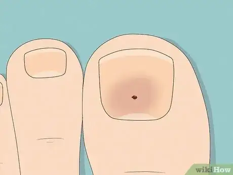 Image titled Remove a Dead Toenail Step 5