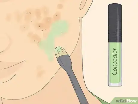 Image titled Get Rid of Cystic Acne Scars Step 17