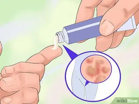 Image titled Treat Genital Warts in Women Step 5