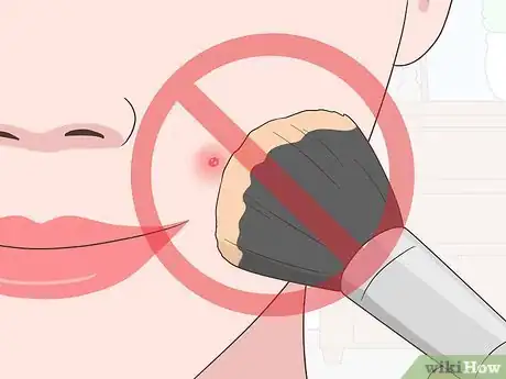 Image titled Stop a Pimple from Forming Step 4