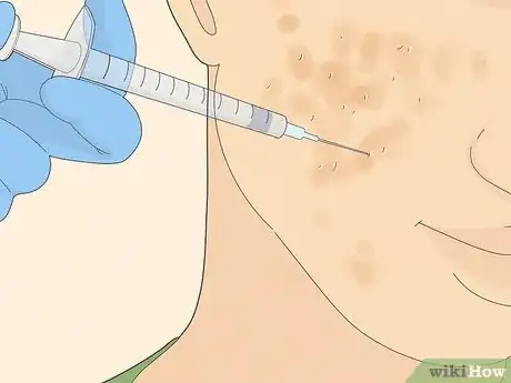 Image titled Get Rid of Cystic Acne Scars Step 12