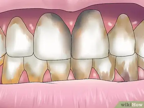 Image titled Reverse Dental Bone Loss Step 13