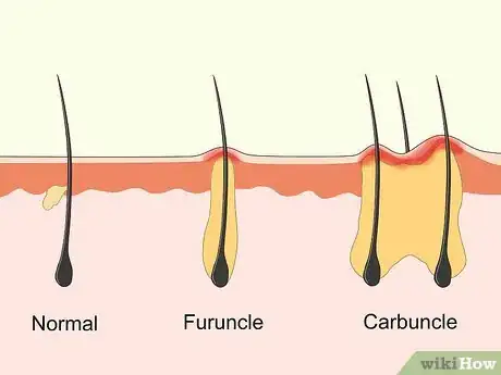 Image titled Treat Carbuncles Step 1