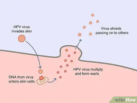 Image titled Treat Periungual Warts Step 3