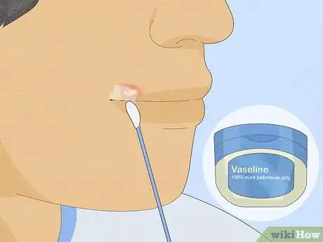 Image titled Get Rid of a Cold Sore Fast Step 8