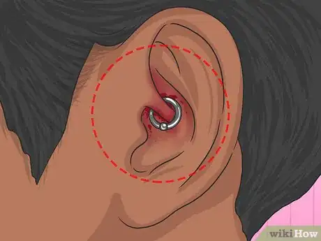 Image titled Clean a Daith Piercing Step 11