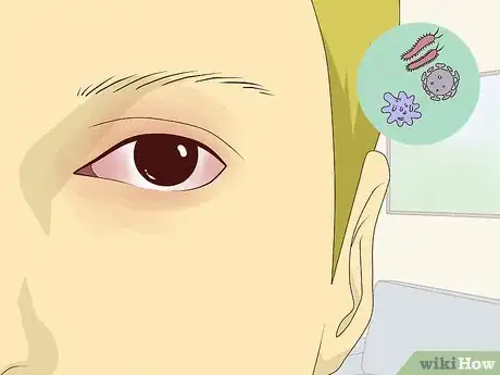 Image titled Stop Your Eye from Itching Step 4