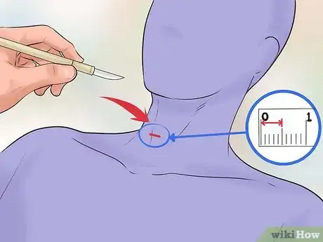 Image titled Perform a Tracheotomy Step 10