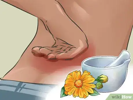 Image titled Use Herbs for Sprains and Bruises Step 5