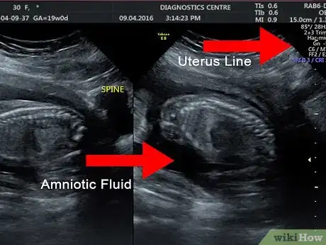 Image titled Read an Ultrasound Picture Step 5