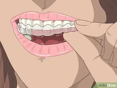 Image titled Straighten Your Teeth Without Braces Step 11