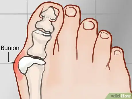 Image titled Straighten Toes Step 4