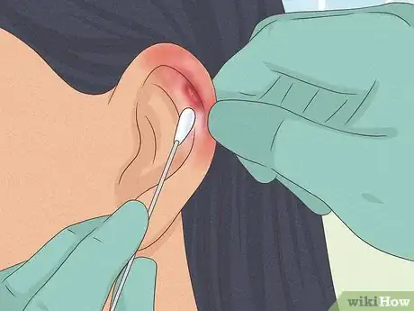 Image titled Heal Cartilage Piercing Bumps Step 5