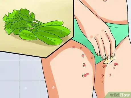 Image titled Ease Herpes Pain with Home Remedies Step 15