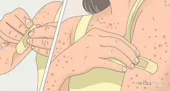 Prevent Chicken Pox Scars