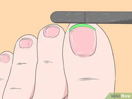 Image titled Fix Thick Toenails Step 5