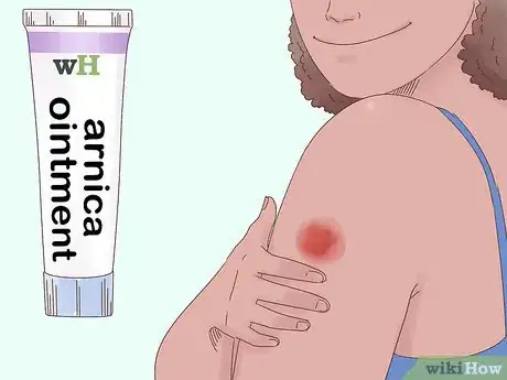 Image titled Get Rid of Bruises Step 11