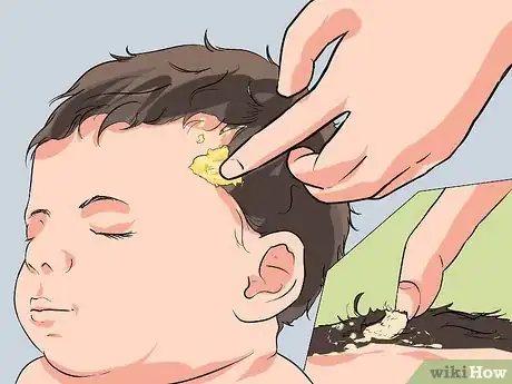 Image titled Prevent Cradle Cap Step 5