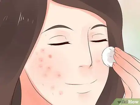 Image titled Get Rid of Acne Redness Step 1