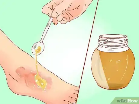 Image titled Treat a Burn Using Honey Step 5