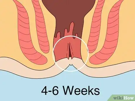 Image titled Care for Anal Fissures Postpartum Step 8