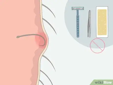 Image titled Get Rid of Ingrown Pubic Hair Step 1