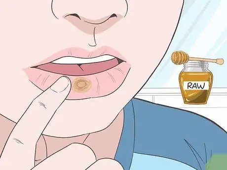 Image titled Treat Mouth Ulcers Naturally Step 1