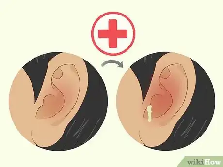 Image titled Heal a Ruptured Eardrum Step 15