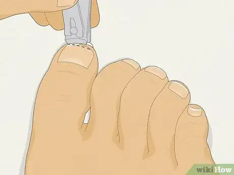 Image titled Treat Toe Nail Fungus Step 4