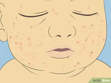 Image titled Know What to Expect on a Newborn's Skin Step 10